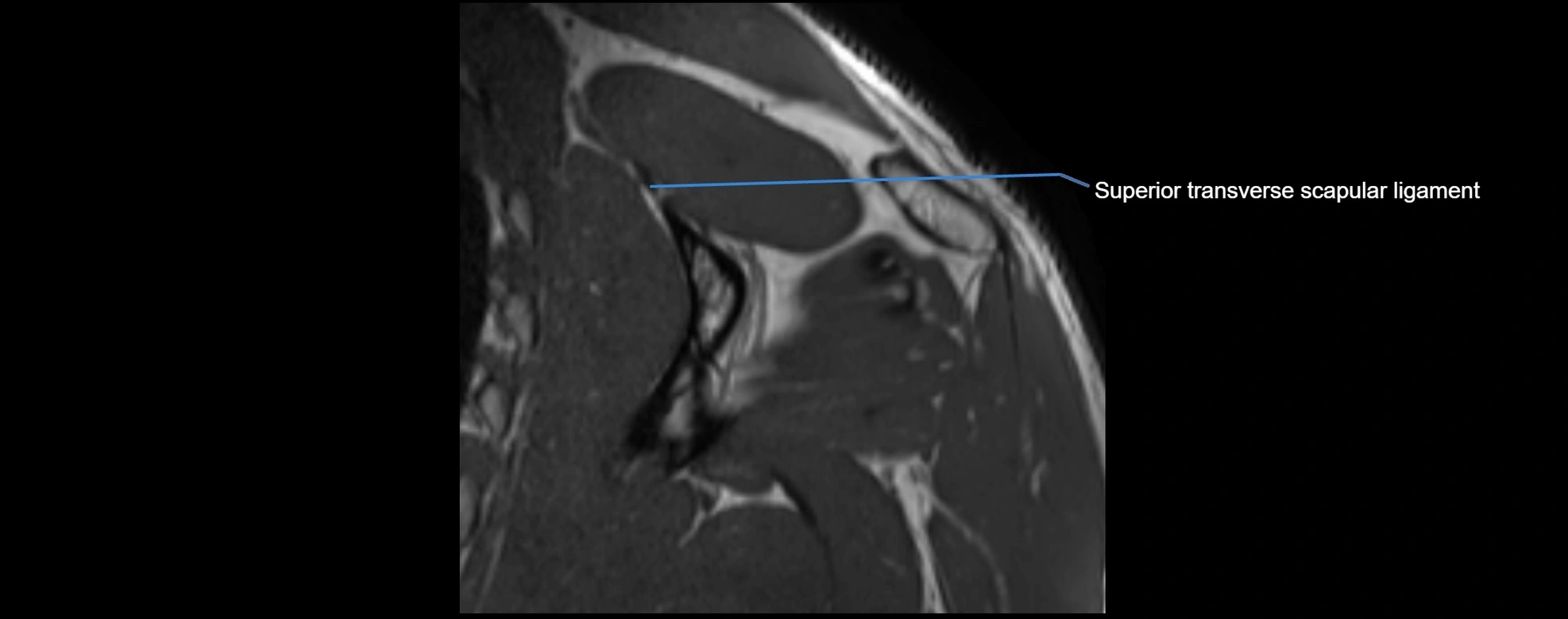 shoulder ligments coronal  cross sectional anatomy 3T MRI AI enhanced radiology image -img-00001-00038.webp